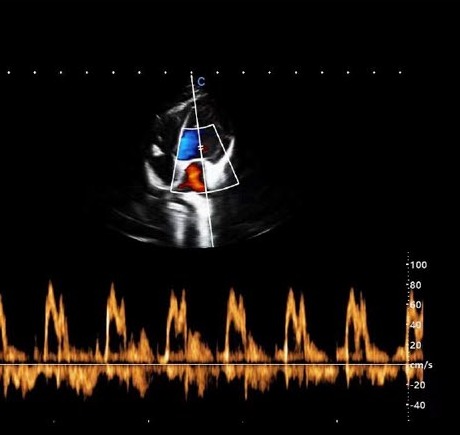 УЗИ сердца в режиме PW на CHISON SonoPort Ultramatrix VET