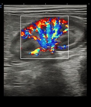 УЗИ почки в режиме ЦДК на CHISON SonoPort Ultramatrix VET